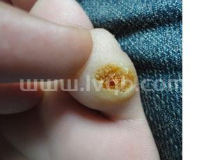 鸡眼贴到好的全部过程,贴鸡眼膏痊愈过程