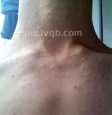 长肉粒是怎么回事,脖子上长小肉粒是什么原因